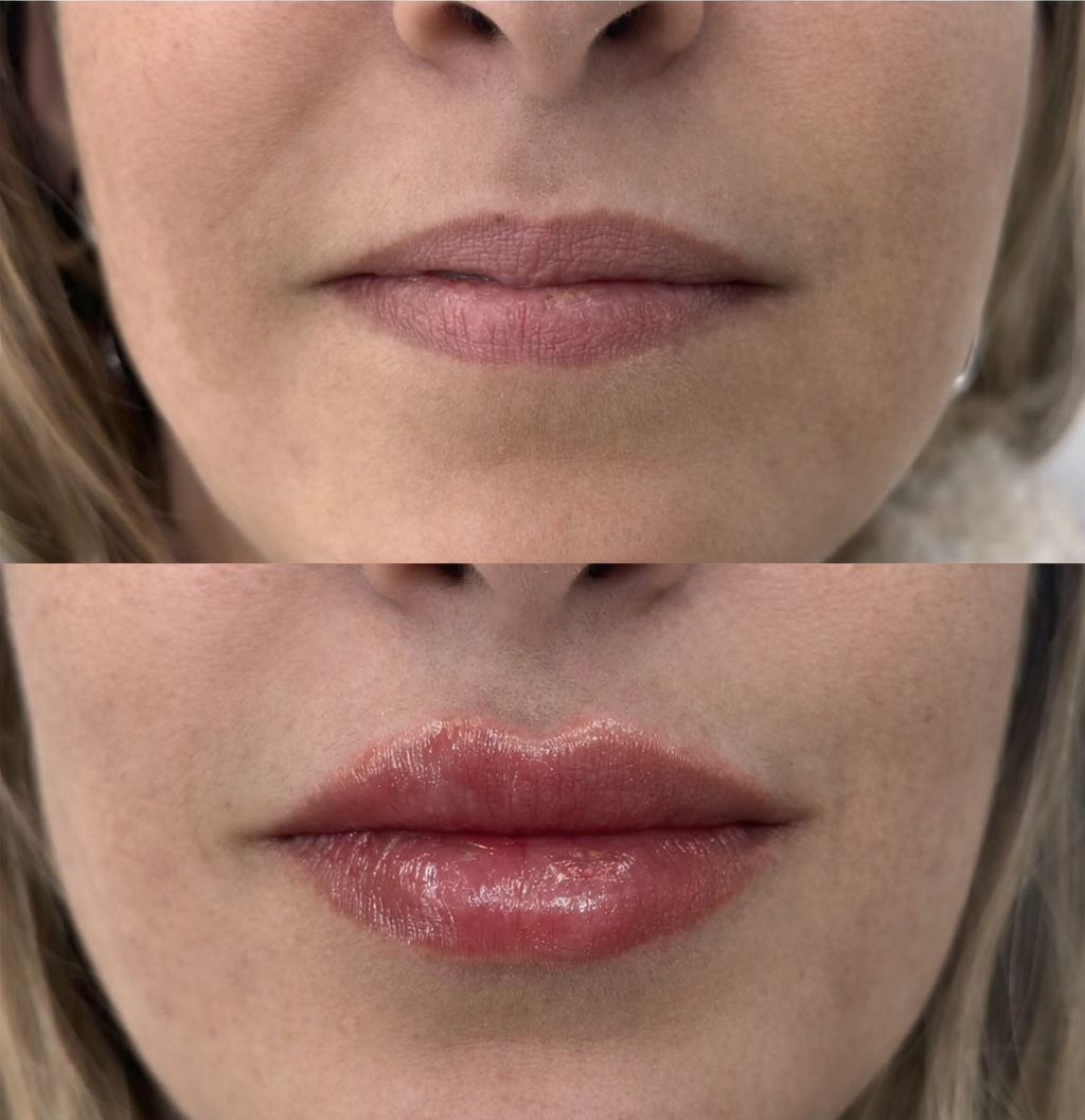 antes e depois de labios