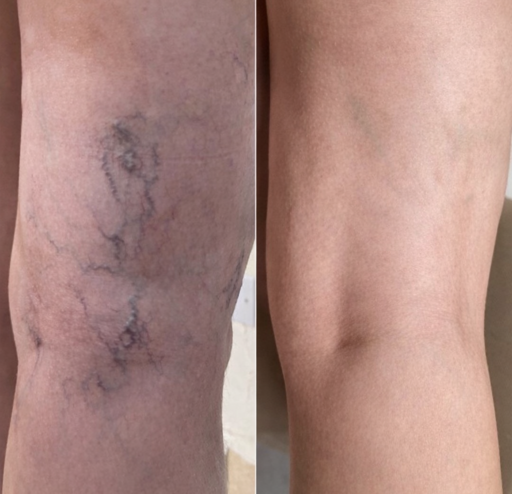 mulher que se livrou das varises